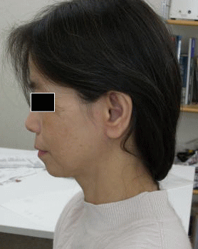 顔全体から首にかけてのアトピー性皮膚炎３か月経過後