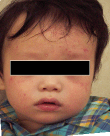 乳児湿疹２か月後