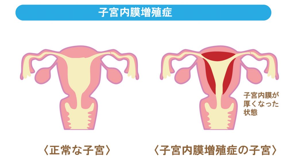 リュープリンは妊娠に役立ちますか?