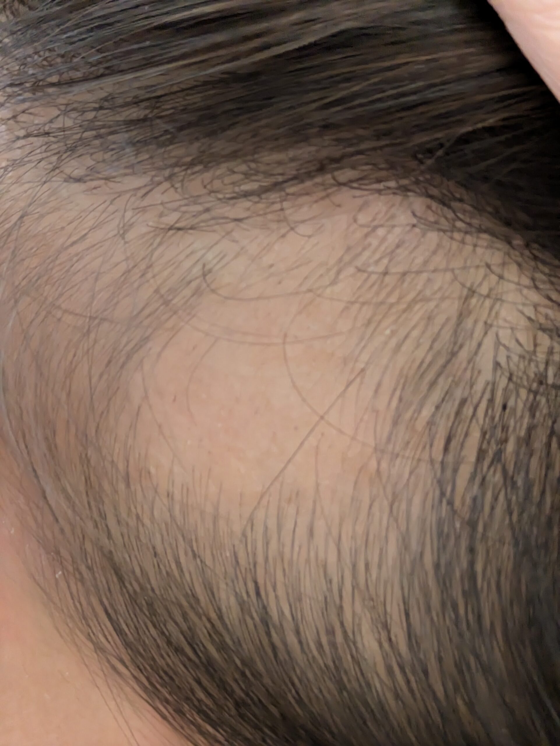 円形脱毛症初回相談日