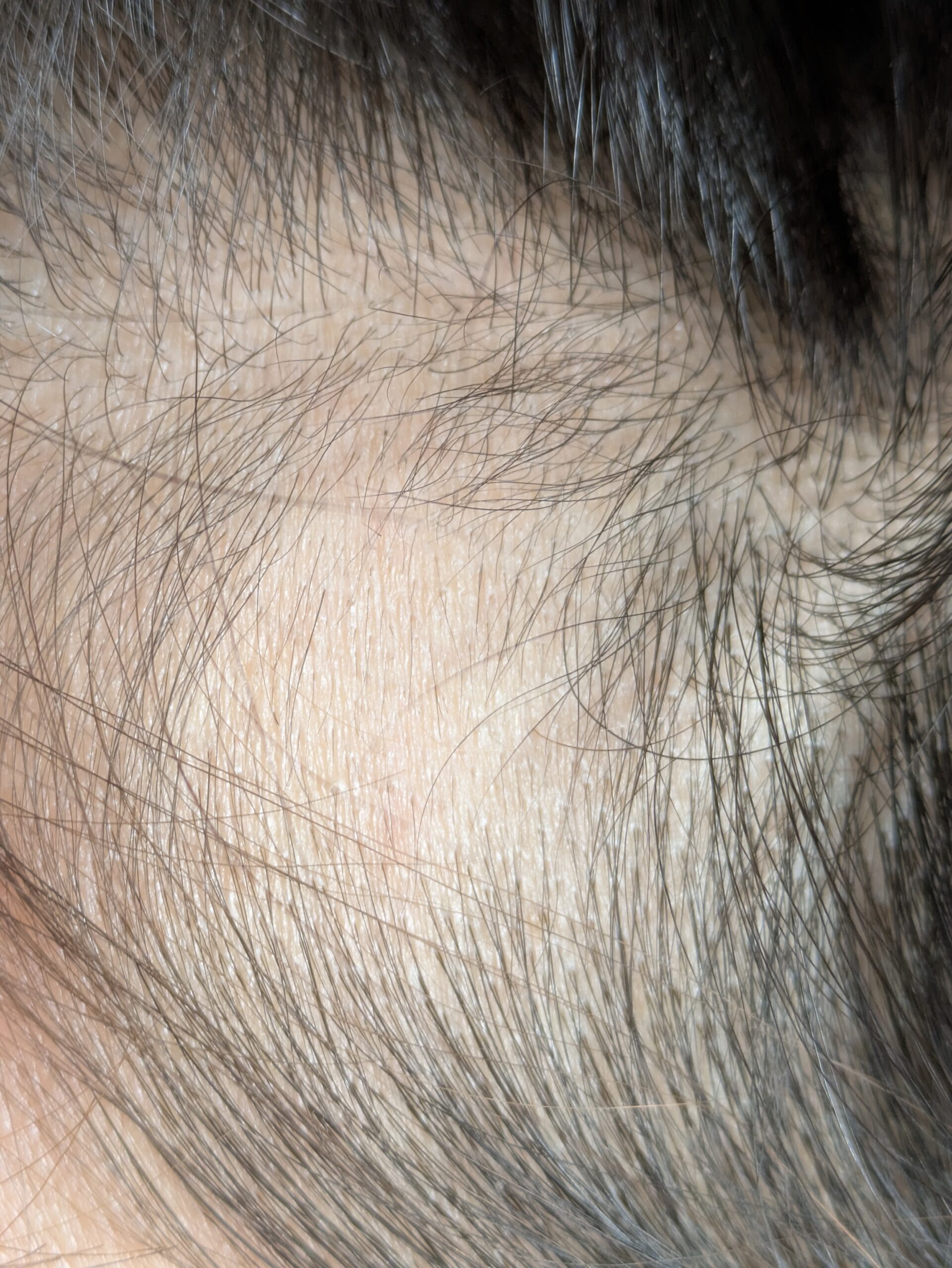 円形脱毛症２回目相談日