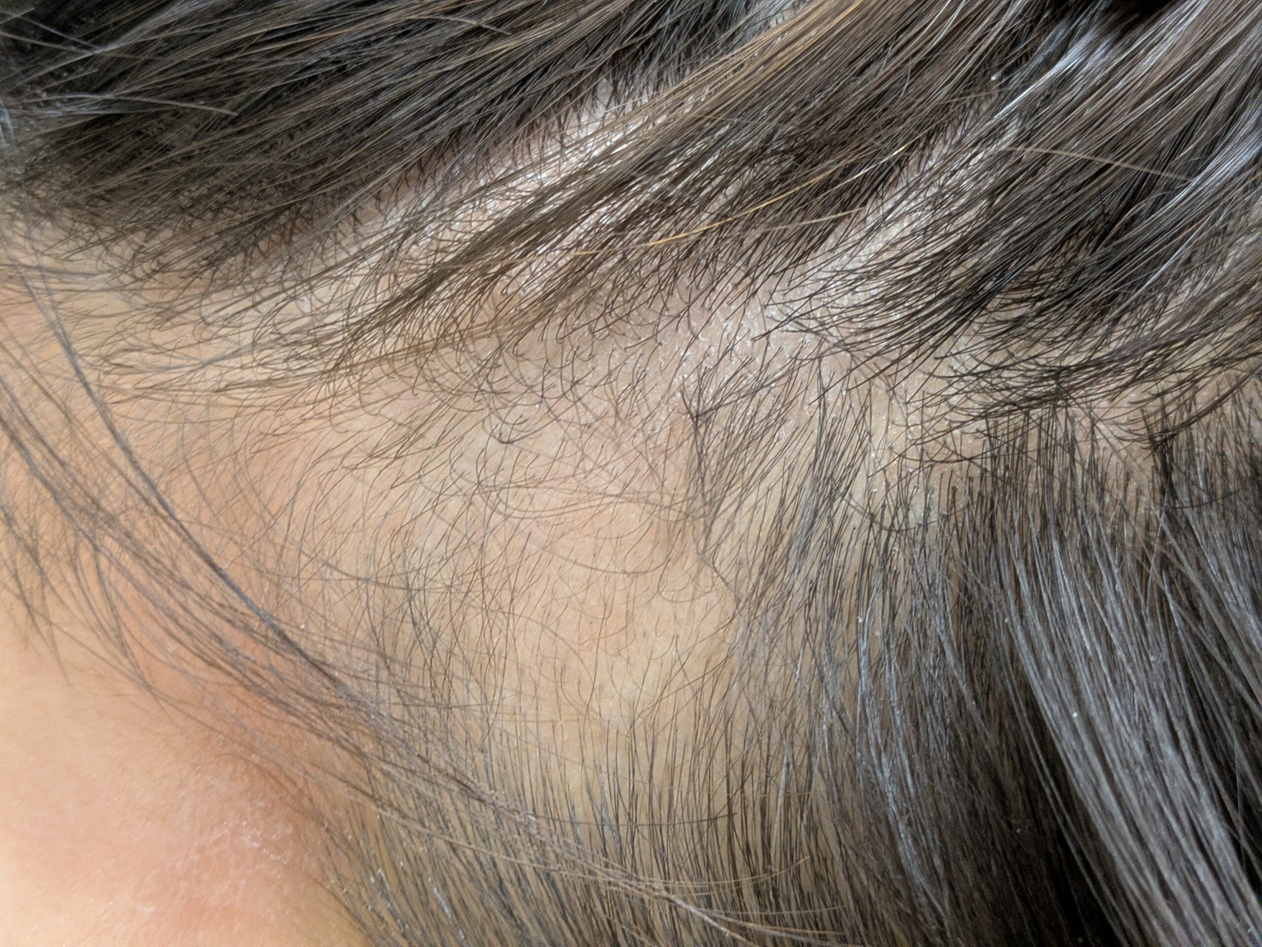 円形脱毛症３回目相談日